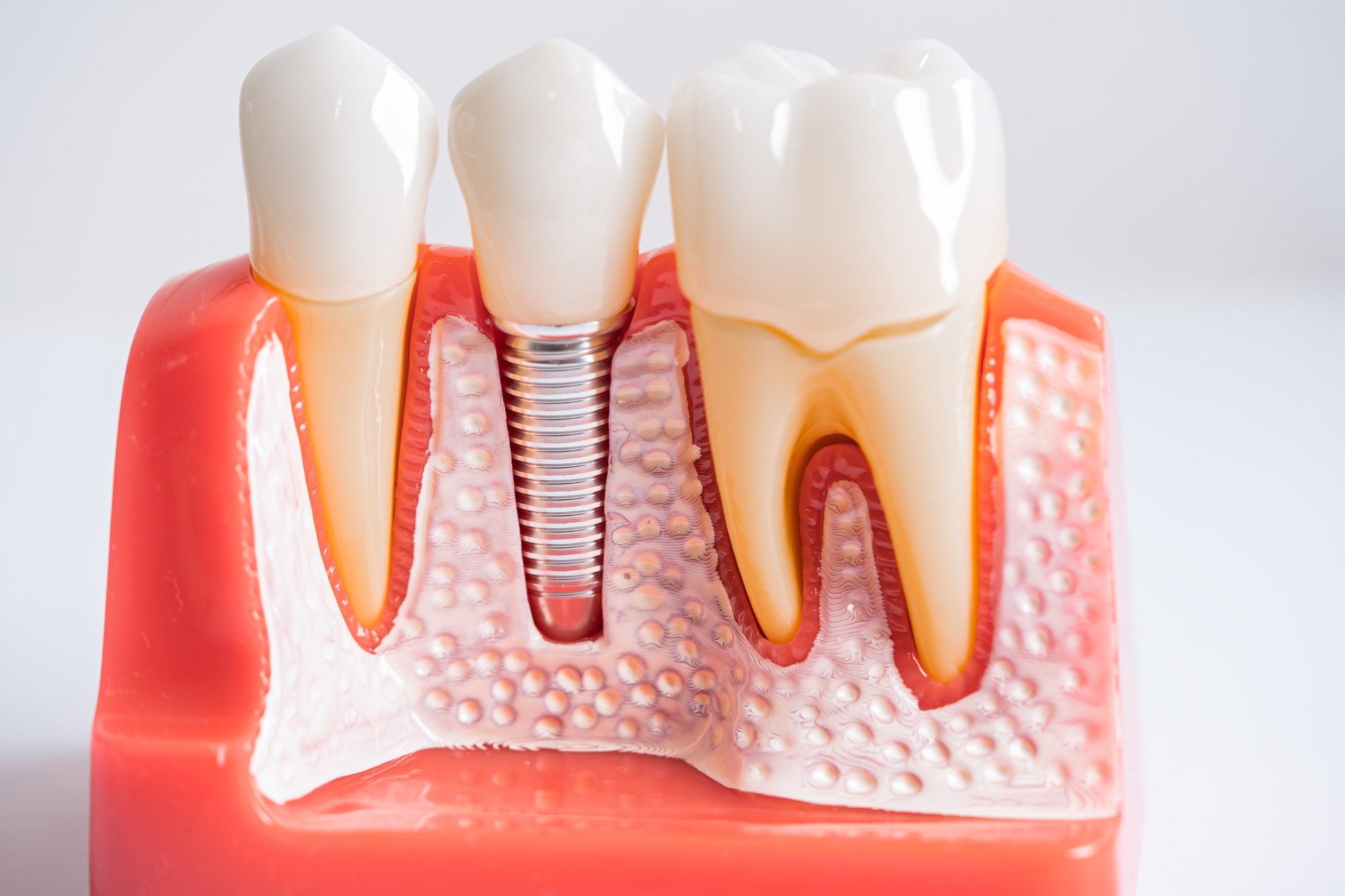 Dental implant, artificial tooth roots into jaw, root canal of dental treatment, gum disease