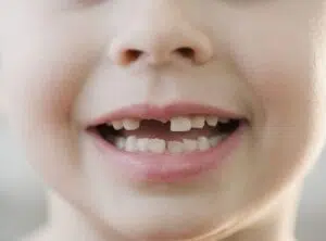 a child with a missing front tooth