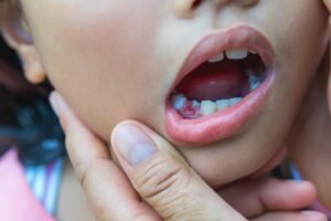 When a 2-Year-Old Needs a Partial Denture