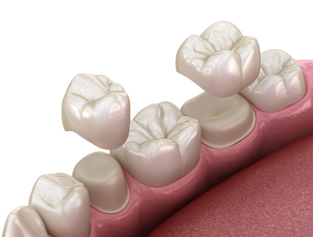 Dental crowns guide in Beverly Hills