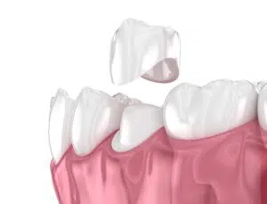 Dental crowns guide in Beverly Hills