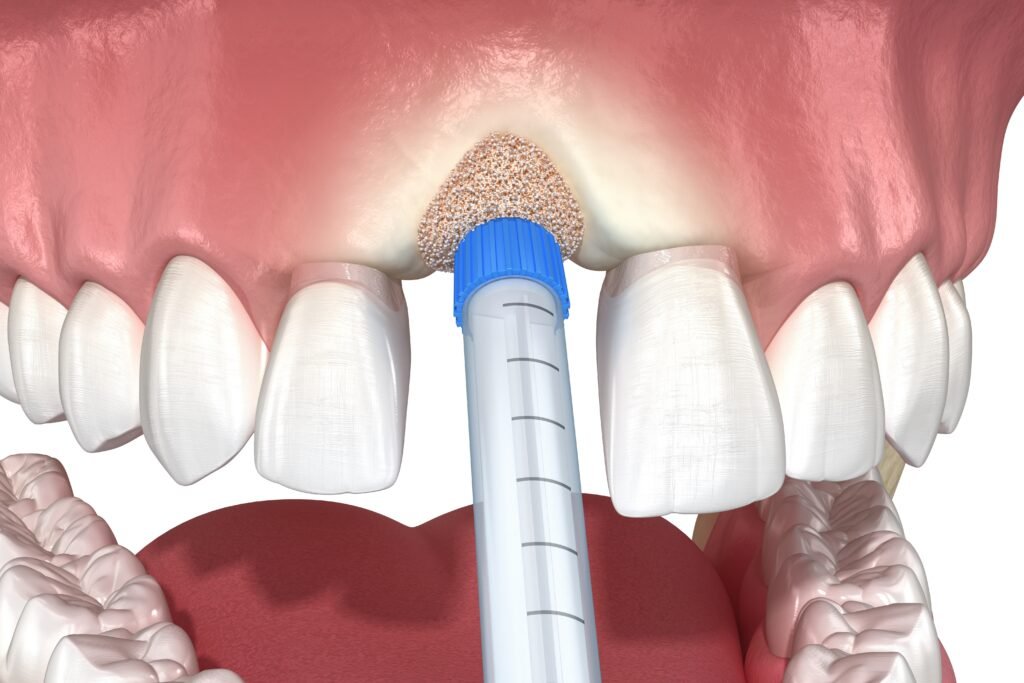 Bone graft for dental implant in Beverly Hills