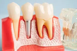 Dental Implant Cost in Beverly Hills