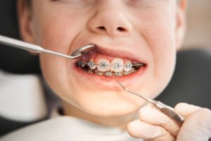 Orthodontics: Fixing Bites While Your Child is Still Growing