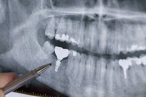 Digital dental X-rays and diagnostics in Beverly Hills by Dr. Sepehr Nassiripour, DDS