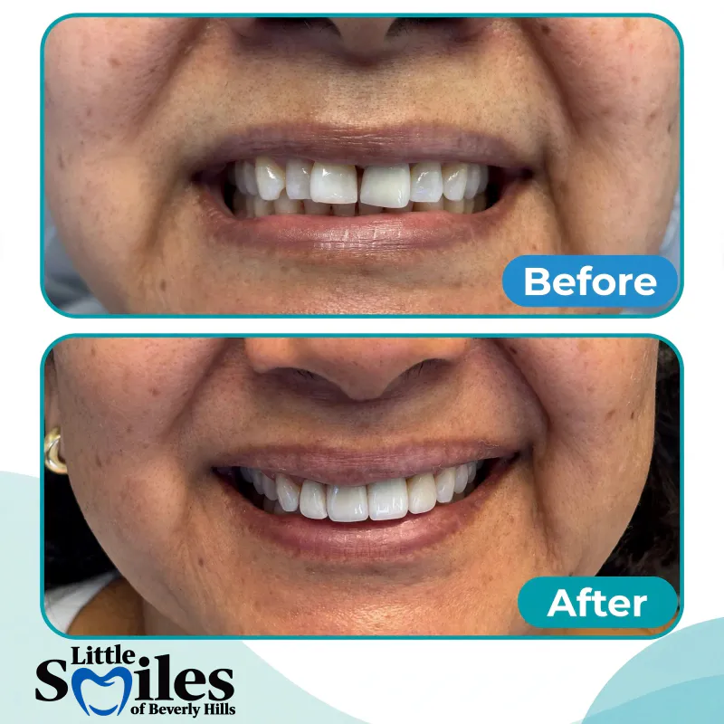 4 crowns to improve esthetic and function-before-after